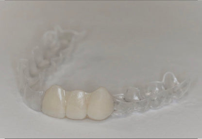 "Custom clear dental retainer with acrylic false tooth"