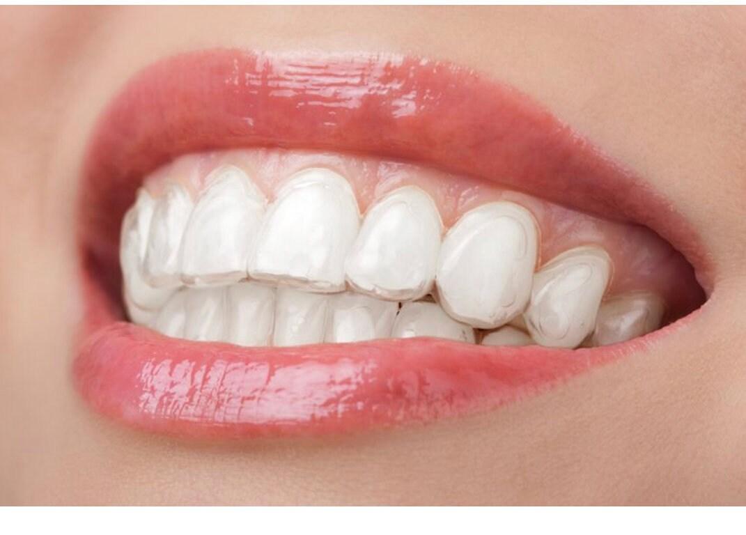Clear Retainer